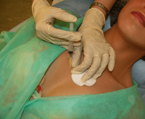 Introducerea mezo-cocktailului în țesutul mamar - o alternativă la injecțiile cu acid hialuronic