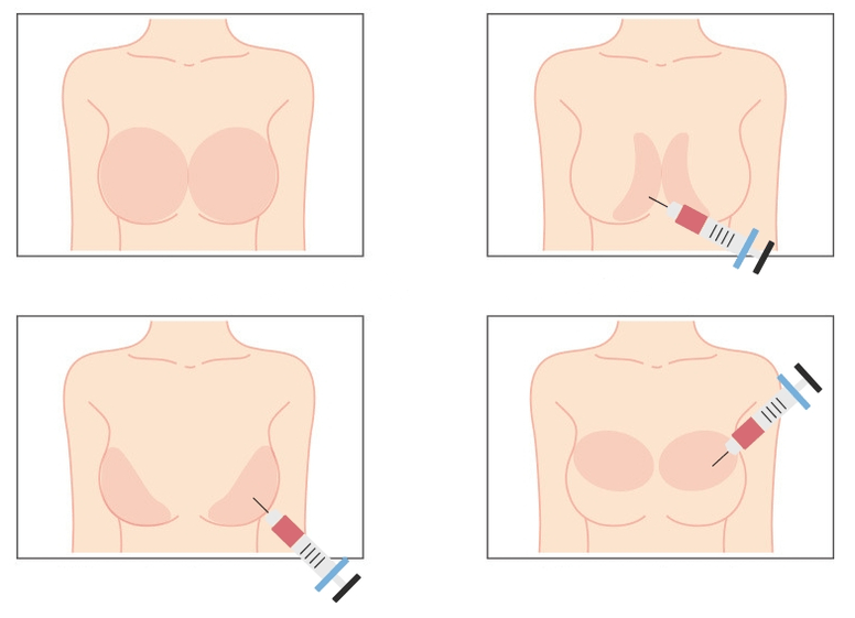 Locuri pentru injectarea acidului hialuronic în sân