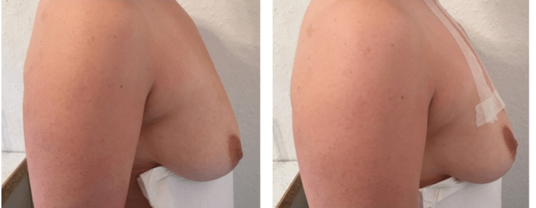 Înainte și după ridicarea sânilor cu fir