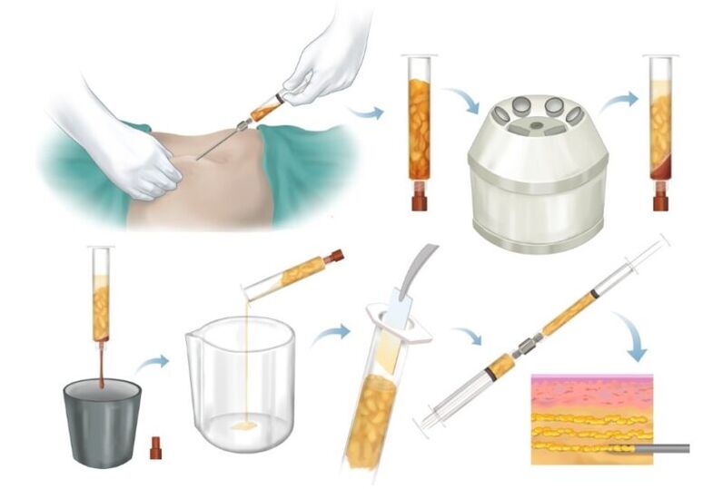 Îndepărtarea grăsimii din zonele cu probleme, procesare și injectare în țesutul mamar