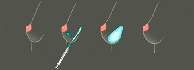 Procedura de injectare a acidului hialuronic în sân