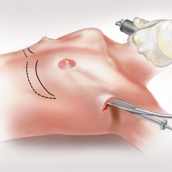 Mărirea endoscopică a sânilor